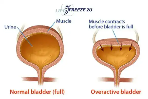 diagram of overactive bladder treatment Wantage