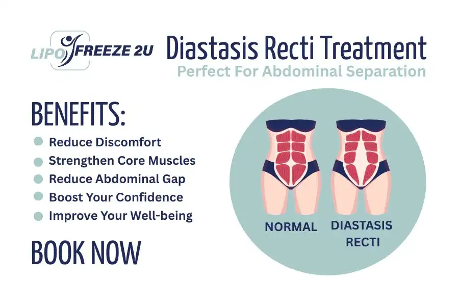 How Long Will It Take to See Improvements in Diastasis Recti Wantage