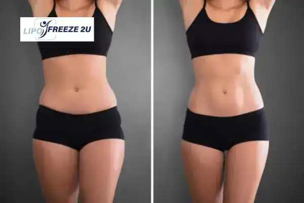 How Can LIPO FREEZE 2U Support Your Post-Pregnancy Body Recovery Wantage?