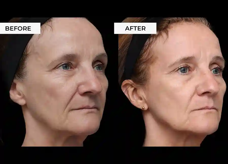 How Many RF Microneedling Sessions Will You Need to See a Difference Wantage?