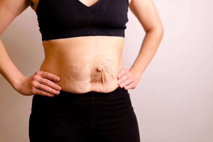 Is Surgery Really the Only Way to Repair Diastasis Recti Wantage?
