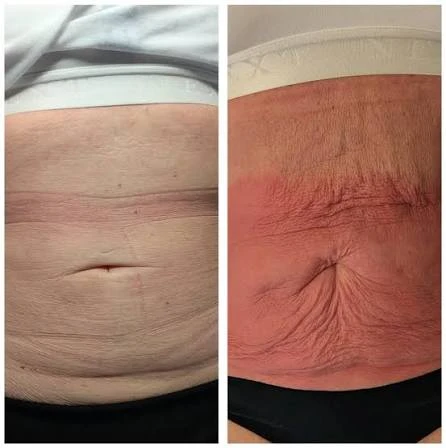 How Does RF Microneedling Improve Crepey, Thin and Uneven Skin Texture Wantage?