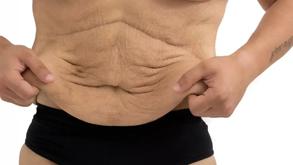 Why Does Weight Loss Medication Leave Some People With Loose or Sagging Skin Wantage?